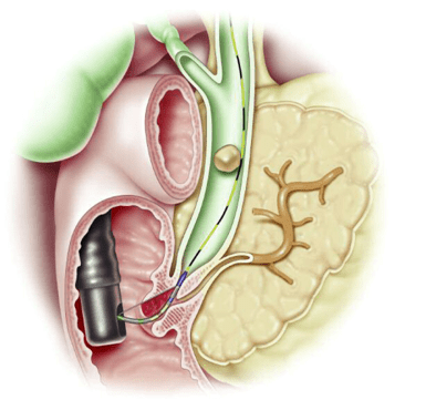 Endoscopic Retrograde Cholangiopancreatography (ERCP) Image